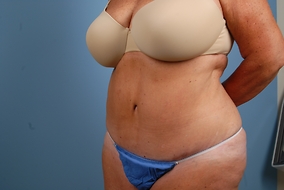 Abdominoplasty Before & After Image