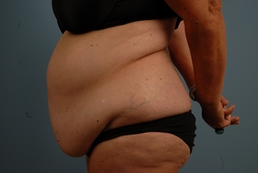 Abdominoplasty Before & After Image