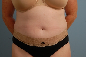 Abdominoplasty Before & After Image