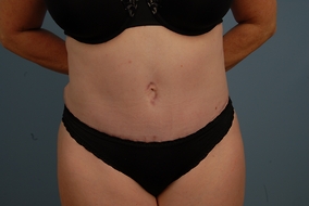 Abdominoplasty Before & After Image