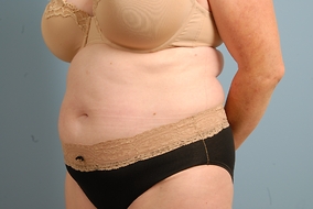 Abdominoplasty Before & After Image