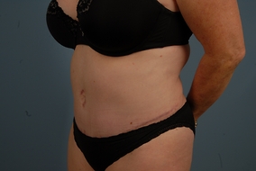 Abdominoplasty Before & After Image