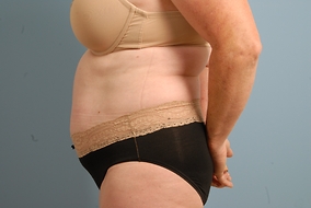 Abdominoplasty Before & After Image