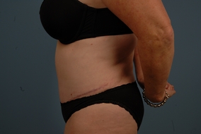 Abdominoplasty Before & After Image