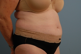 Abdominoplasty Before & After Image