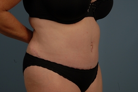 Abdominoplasty Before & After Image