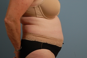 Abdominoplasty Before & After Image