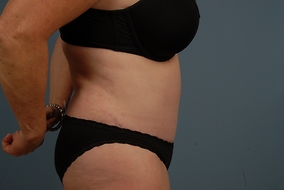 Abdominoplasty Before & After Image