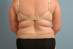 Abdominoplasty Before & After Image