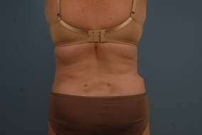 Abdominoplasty Before & After Image