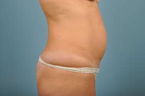 Abdominoplasty Before & After Image