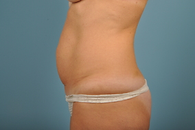 Abdominoplasty Before & After Image