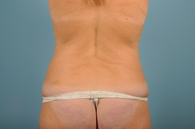 Abdominoplasty Before & After Image