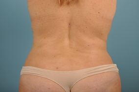 Abdominoplasty Before & After Image