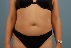 Abdominoplasty Before & After Image