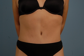 Abdominoplasty Before & After Image