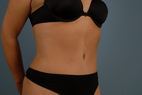 Abdominoplasty Before & After Image