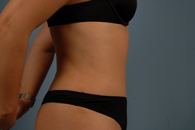 Abdominoplasty Before & After Image