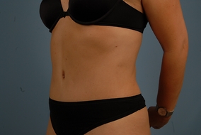 Abdominoplasty Before & After Image