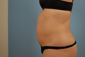 Abdominoplasty Before & After Image