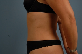 Abdominoplasty Before & After Image