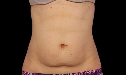 CoolSculpting Before & After Image