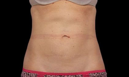 CoolSculpting Before & After Image