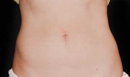 CoolSculpting Before & After Image