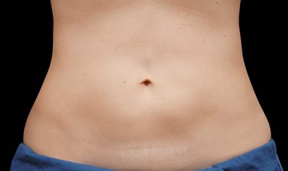 CoolSculpting Before & After Image