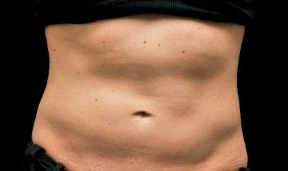 CoolSculpting Before & After Image