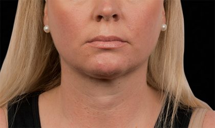 CoolSculpting Before & After Image