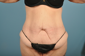 Liposuction Before & After Image