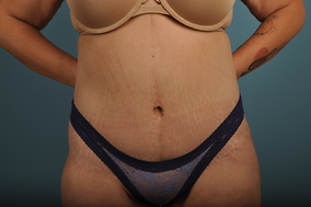 Liposuction Before & After Image