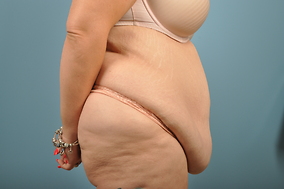 Liposuction Before & After Image