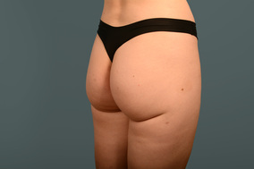 Liposuction Before & After Image