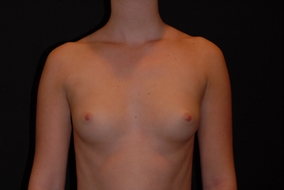 Breast Augmentation Before & After Image