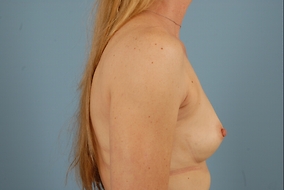 Breast Augmentation Before & After Image