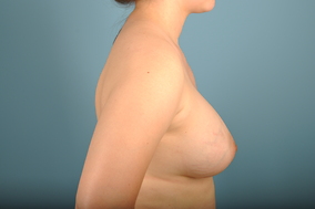 Breast Augmentation Before & After Image