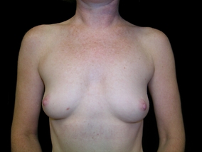 Breast Augmentation Before & After Image