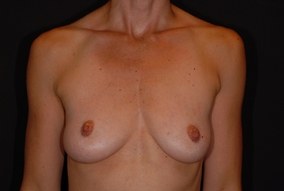 Breast Lift With Implants Before & After Image