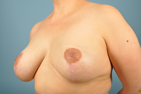 Breast Lift Before & After Image