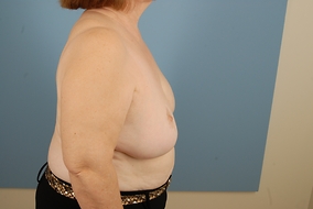 Breast Reduction Before & After Image