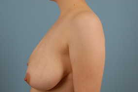 Breast Reduction Before & After Image