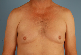 Male Breast Reduction Before & After Image