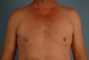 Male Breast Reduction Before & After Image