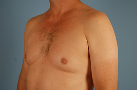 Male Breast Reduction Before & After Image