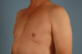 Male Breast Reduction Before & After Image