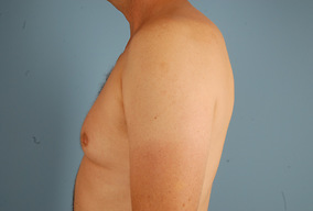 Male Breast Reduction Before & After Image