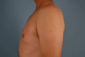 Male Breast Reduction Before & After Image