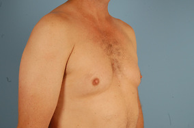 Male Breast Reduction Before & After Image